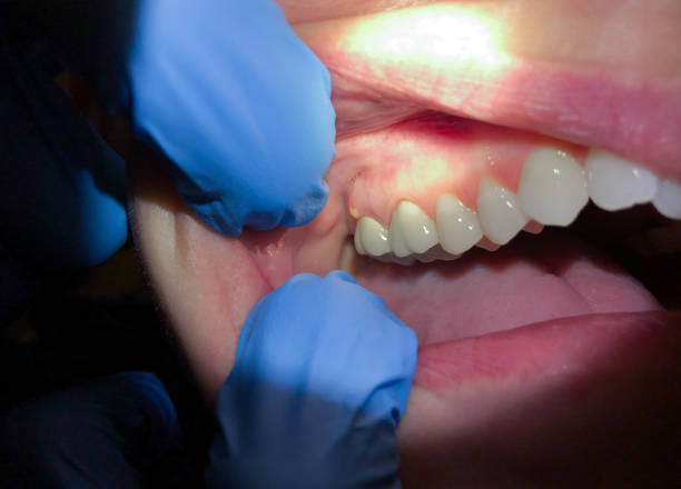 Best Broken or Chipped Tooth Repair in Cottonwood, MN